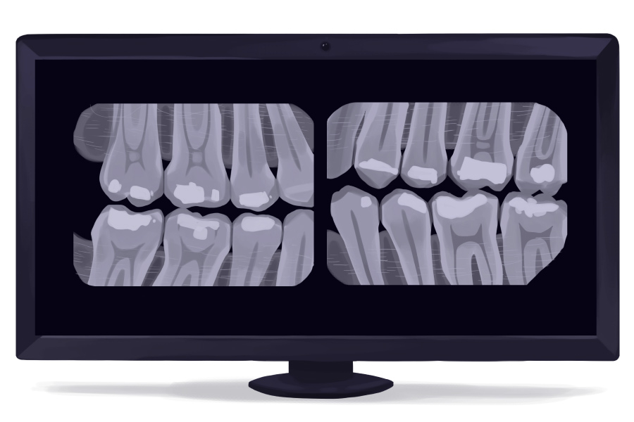 xray of baby teeth